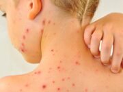 يتم تقديم لقاح جدري الماء على NHS العام المقبل ، كجزء من الروتينية MMR JAB للأطفال | العلوم والمناخ والتكنولوجيا الأخبار